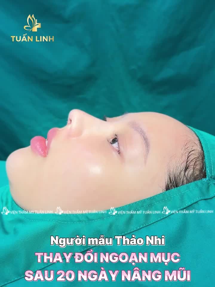 Thảo Nhi  Hành trình 20 ngày ''lột xá.c" xinh đẹp sắc nét, cân mọi góc hình với chiếc mũi cao thanh tú.