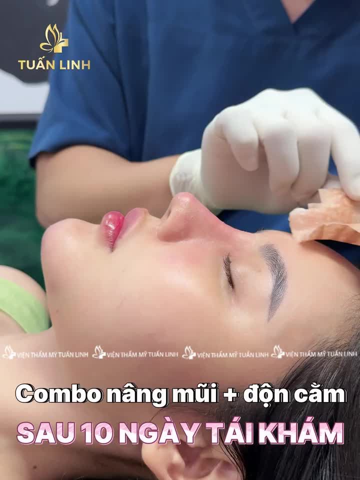 COMBO MŨI + CẰM SAU 10 NGÀY TÁI KHÁM - ĐẸP HÀI HÒA!