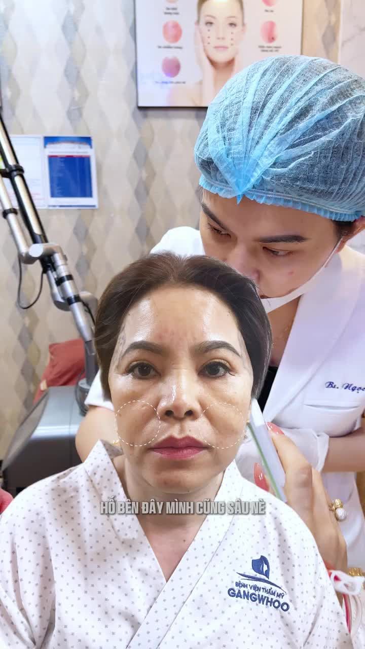 Cải thiện rãnh cười sâu cho chị khách sau 1 lần tiềm Filler