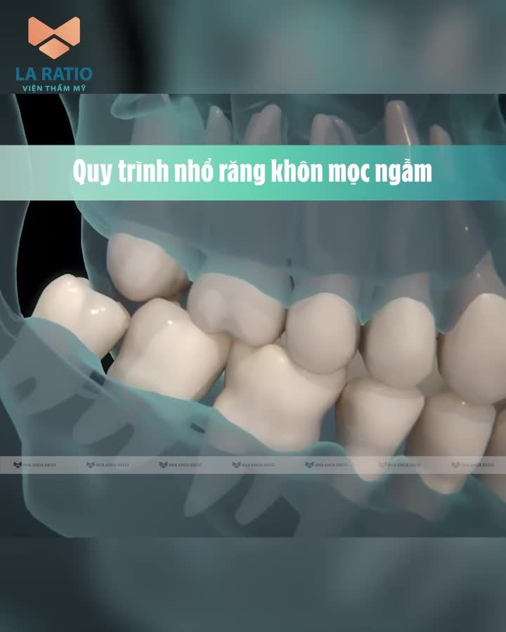 Quy trình nhổ răng khôn gồm các bước nào?