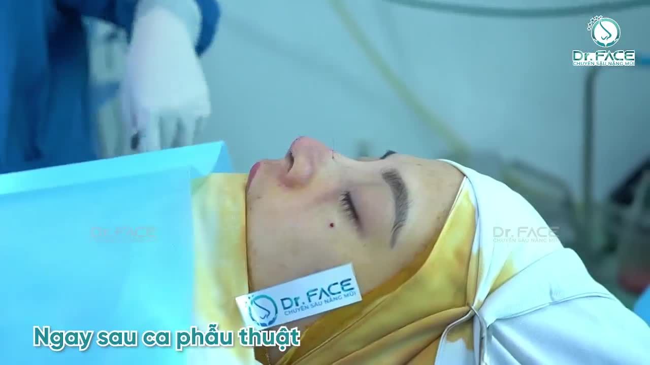 Nâng Sụn Sườn + Cấy Mỡ Mí Dưới Cho Cô Kế Toán Ở Philippines