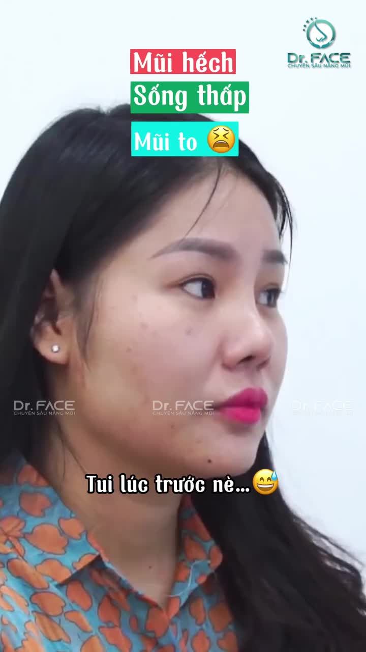 Nâng mũi xong ĐƯỢC LÀM CÔ DÂU…