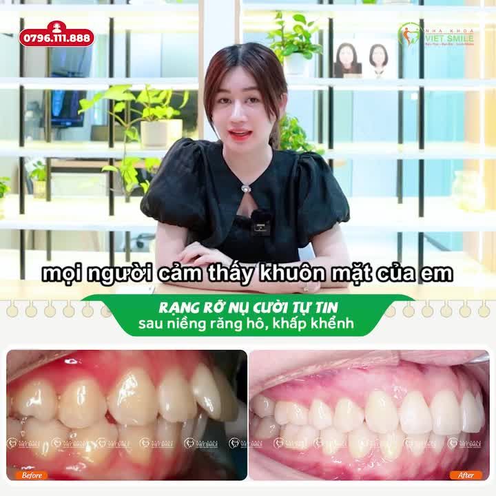 LỰA CHỌN ĐÚNG ĐẮN, SÁNG SUỐT KHI NIỀNG RĂNG TẠI VIET SMILE