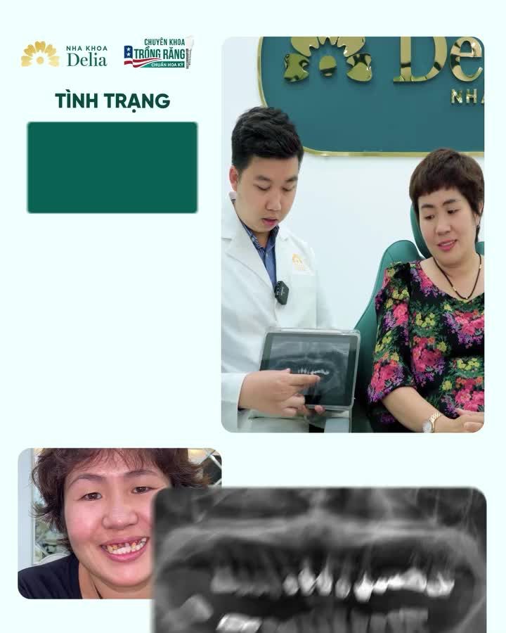 Tình trạng răng hỏng nặng, nhiều bệnh lý trên răng từng là nỗi ám ảnh đối với chị Hải