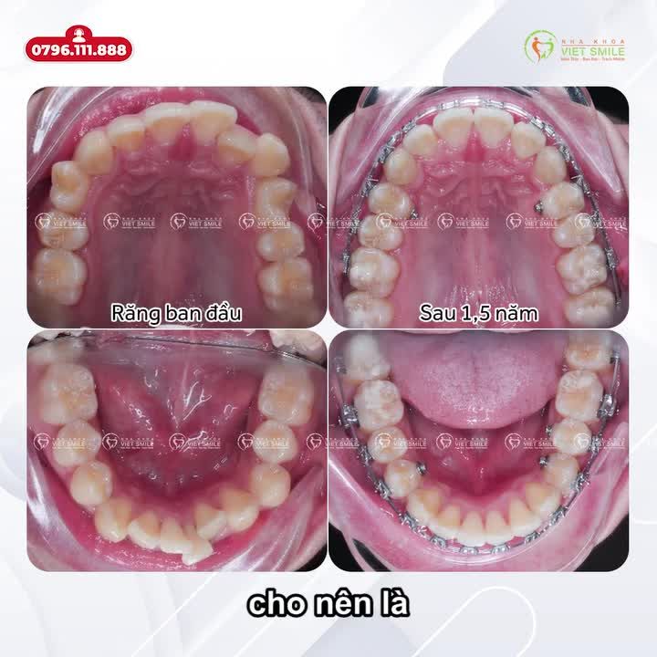 QUYẾT ĐỊNH ĐÚNG ĐẮN KHI CHỌN VIET SMILE ĐỂ NIỀNG RĂNG