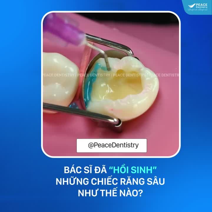 PHỤC HỒI RĂNG SÂU VỠ NHANH CHÓNG BẰNG GIẢI PHÁP TRÁM RĂNG