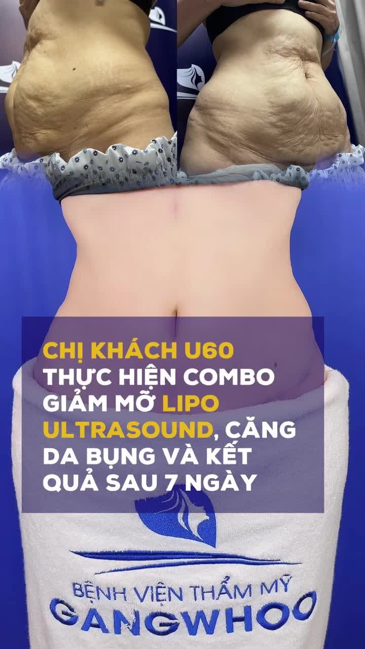 Trả lại vòng 2 thon gọn, nền da mềm mịn săn chắc sau 7 ngày thực hiện combo giảm mỡ Lipo Ultrasound và căng da bụng.