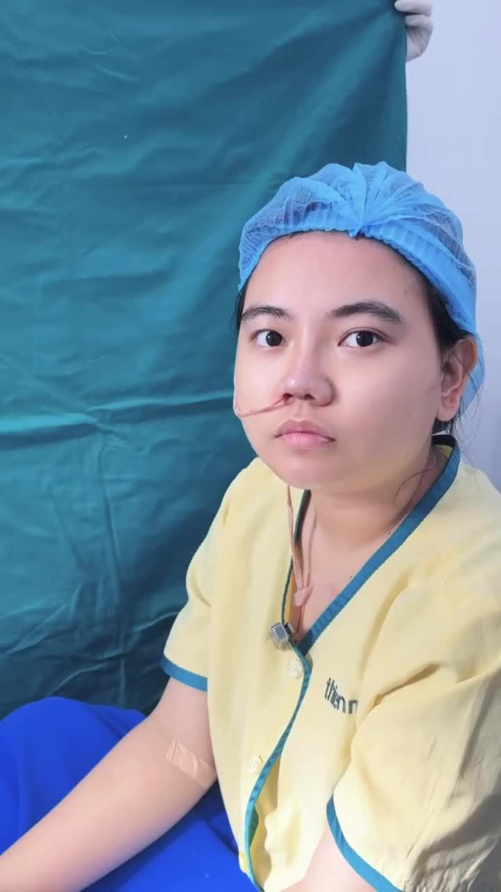 Nâng mũi cấu trúc, chia tay mũi thấp tẹt