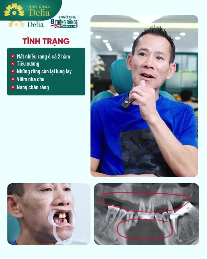 Tin tưởng Bác sĩ tại Delia, anh Hồ đã vượt hơn 14000km từ Canada về Việt Nam trồng răng implant