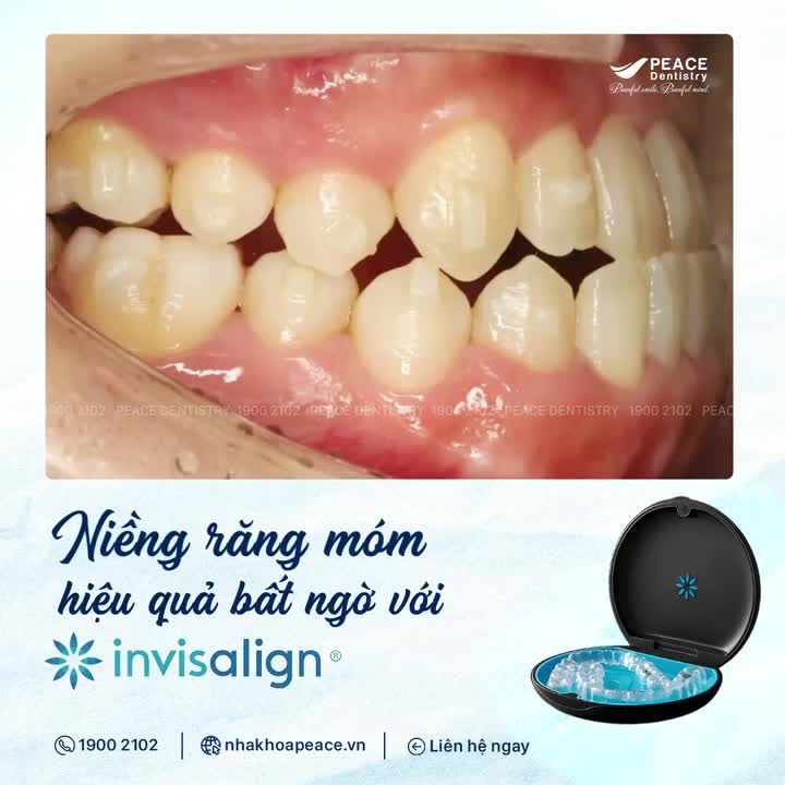 NIỀNG RĂNG MÓM VỚI INVISALIGN: HIỆU QUẢ TRÊN CẢ MONG ĐỢI