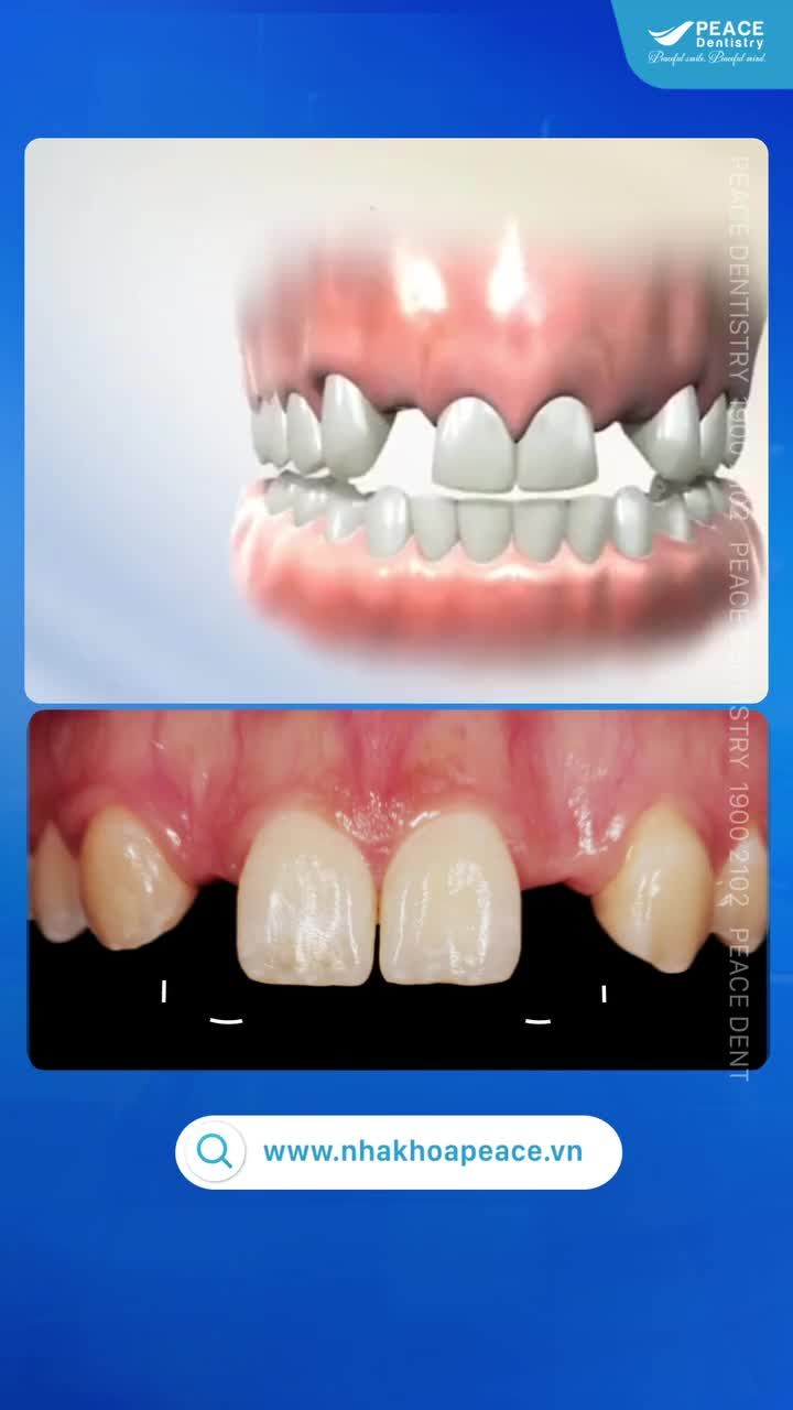 CHỈNH NHA TẠO KHOẢNG ĐỂ CẤY GHÉP IMPLANT: