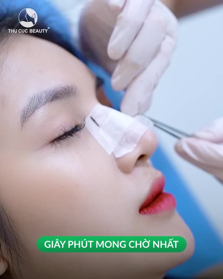 Loại bỏ tình trạng sống mũi thấp, đầu mũi tròn, khiến gương mặt không có điểm nhấn