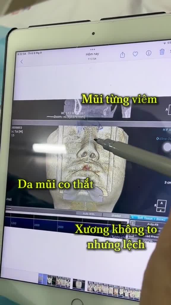 NÂNG MŨI CÓ THÊM GỒ MŨI CÓ ĐƯỢC KHÔNG?