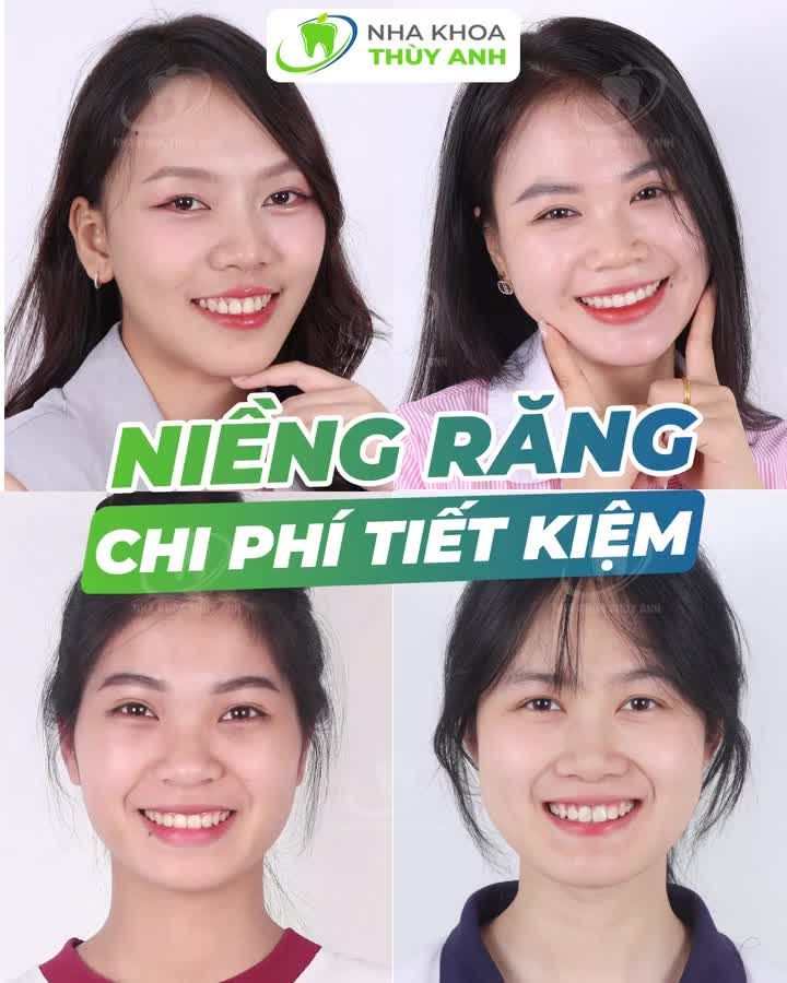 GẤP ĐÔI SỰ XINH ĐẸP SAU NIỀNG RĂNG TẠI NHA KHOA THÙY ANH