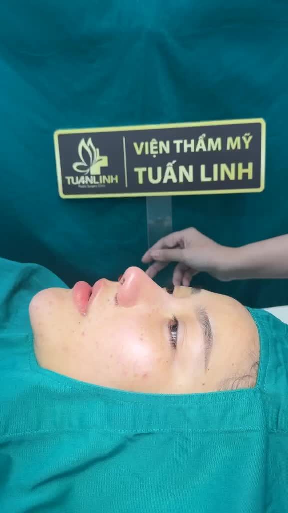 Case mũi cấu trúc + chỉnh vách ngăn + chỉnh hình xương + cuộn cánh vừa hoàn thành