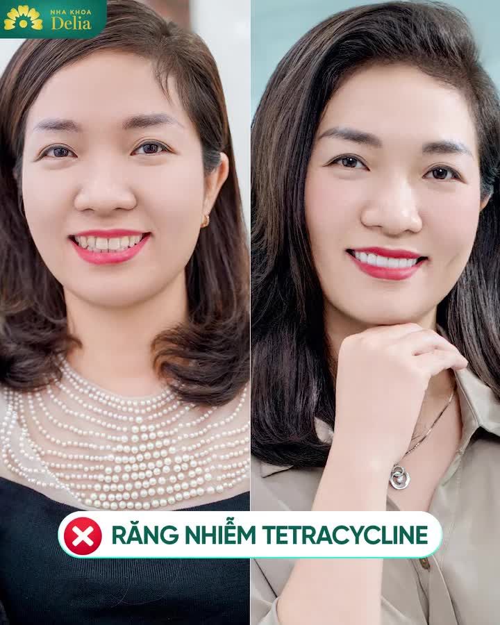 RĂNG Ố VÀNG/ NHIỄM TETRACYCLINE/ KHÔNG ĐỀU/ SỨ HỎNG/ HỞ KẼ >> THẨM MỸ RĂNG SỨ THAY ĐỔI RA SAO?