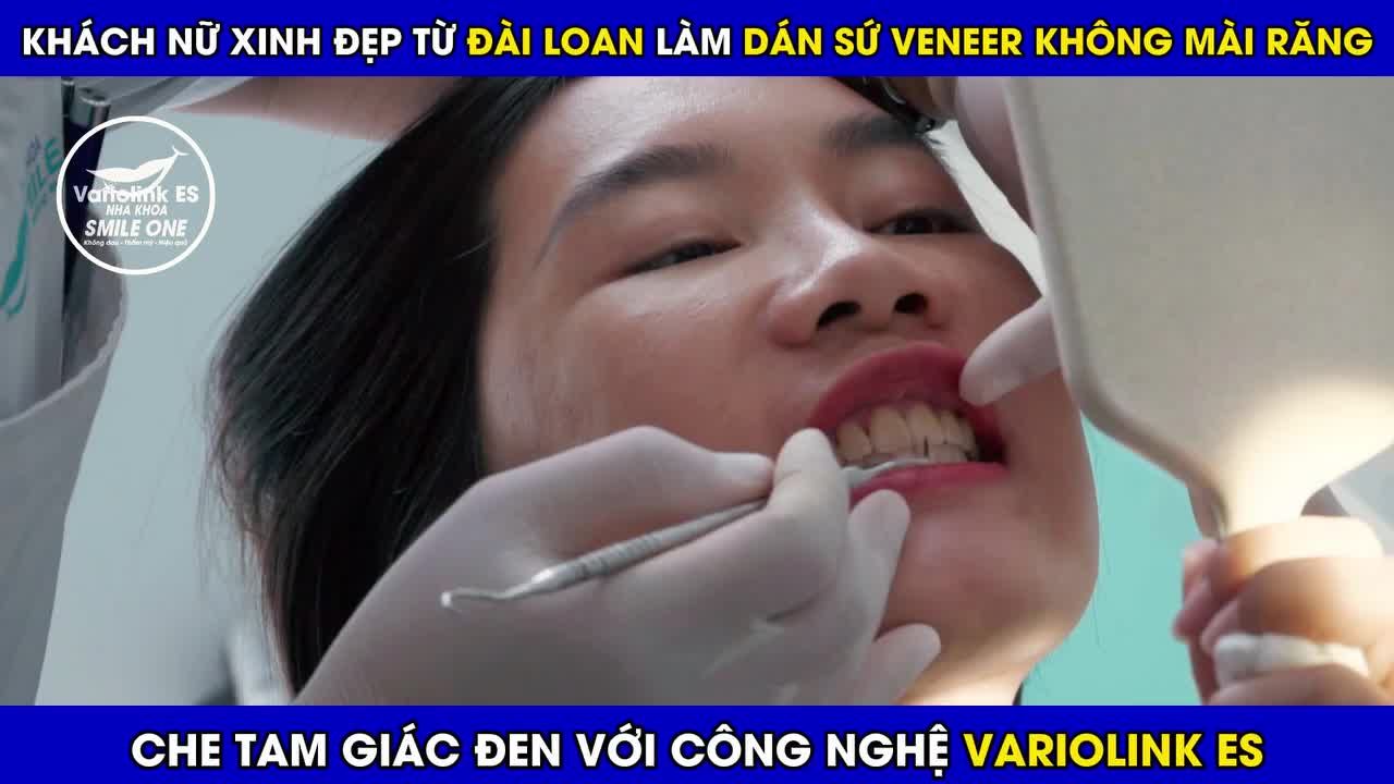 Xem thêm 8 video Mặt Dán Sứ Veneer của bác sĩ Bs nha khoa Smile One