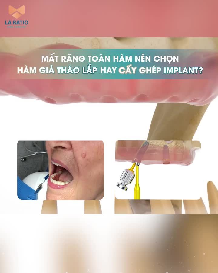 Mất răng toàn hàm nên chọn cấy ghép Implant hay hàm giả tháo lắp?