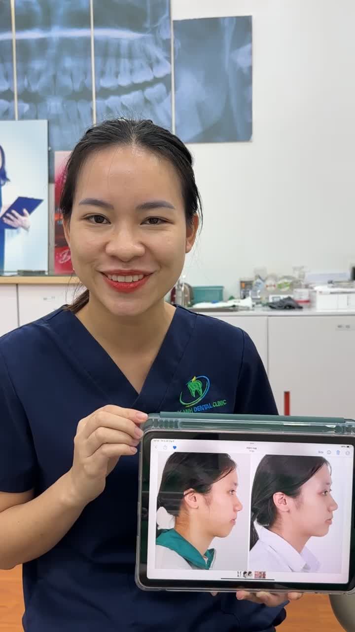 Ca tháo mắc cài cho bạn Thu Hiền (17 tuổi) tại Nha Khoa Thuỳ Anh