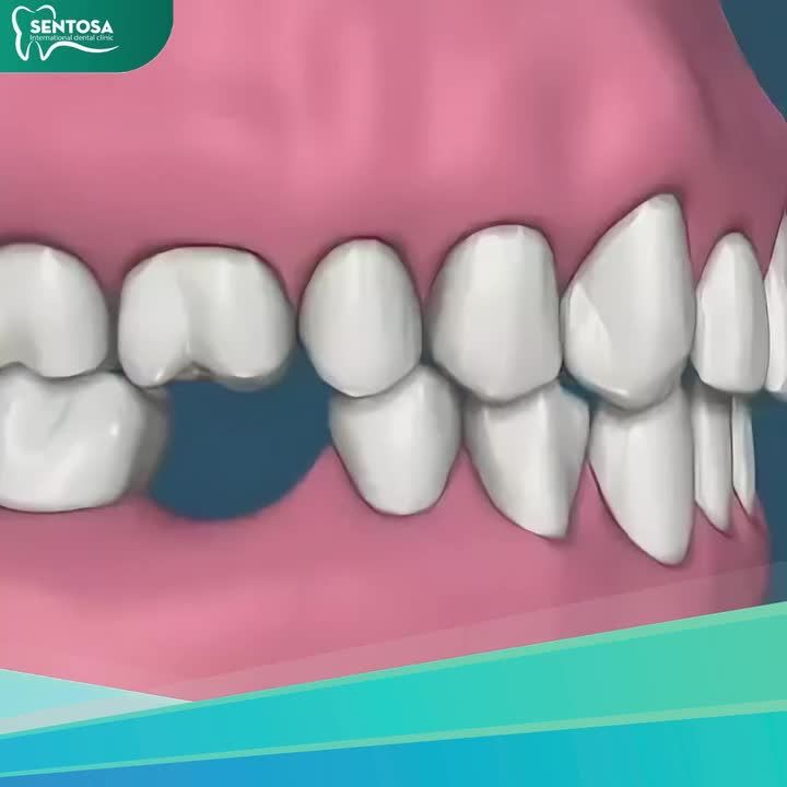 TRỌN GÓI TRỒNG RĂNG CHÍNH HÃNG IMPLANT TỪ 8 TRIỆU/TRỤ