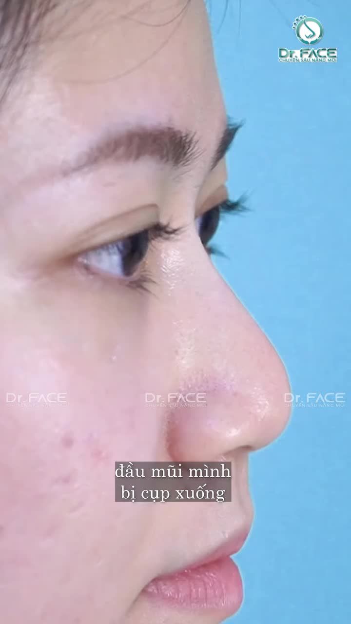 DIỄN BIẾN trong 10 NGÀY NÂNG MŨI sẽ như thế nào?