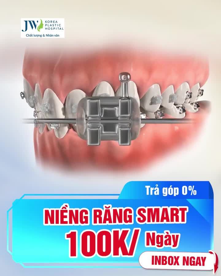 NIỀNG RĂNG SMART TRẢ GÓP 0% LÃI SUẤT TỪ 100K/NGÀY