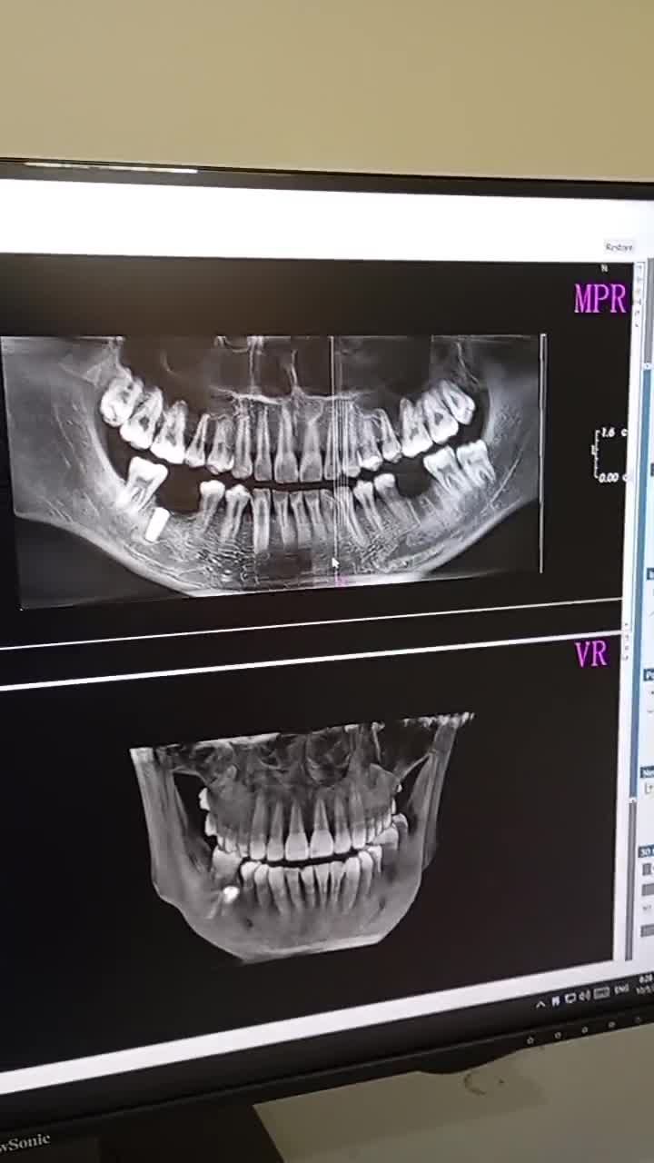 Cấy ghép implant tại nha khoa Quốc tế Việt Pháp