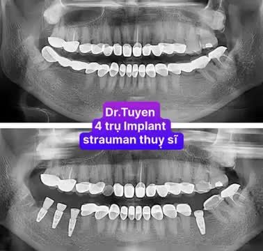 Implant Nha Khoa Có Bền Không?