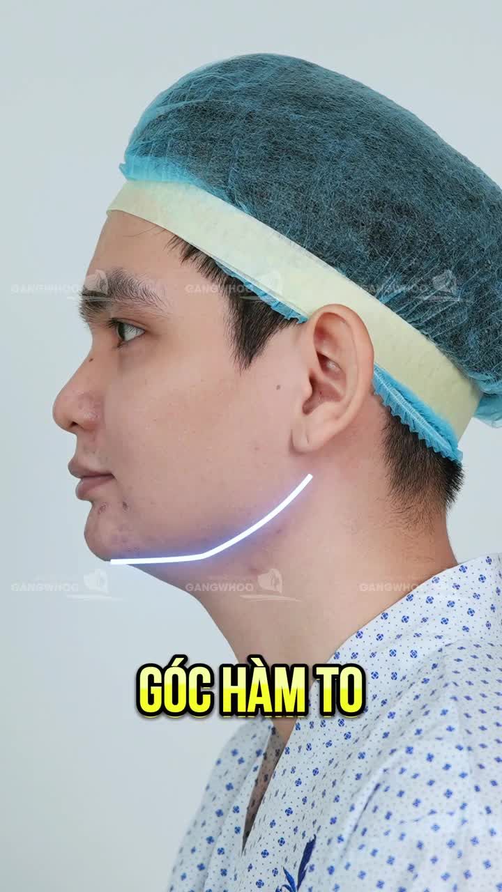 Phương pháp gọt hàm nội soi là phương pháp mà anh Đ. đã chọn với hy vọng cải thiện lại gương mặt vuông và thô của mình.