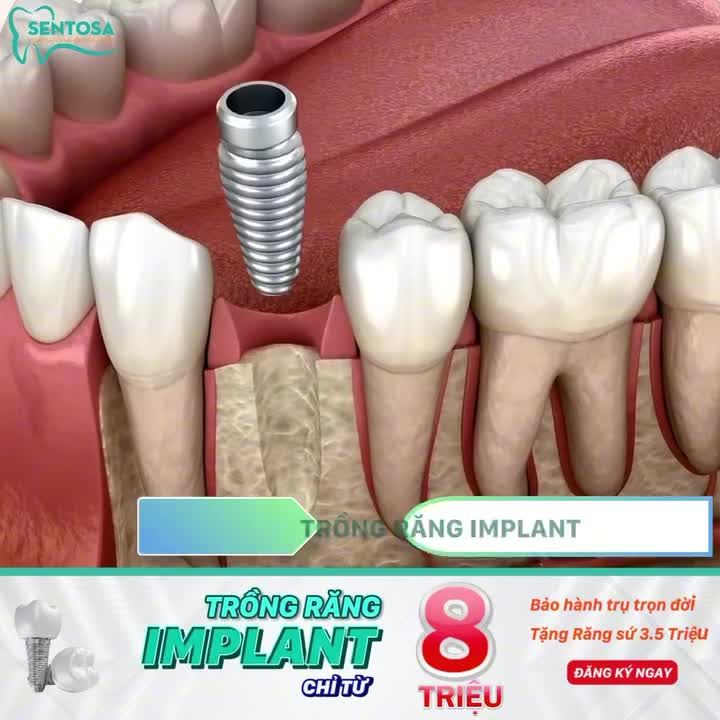 GIÁ ƯU ĐÃI TỪ 8 TRIỆU CHO KHÁCH HÀNG MẤT 1 RĂNG - MẤT NHIỀU RĂNG