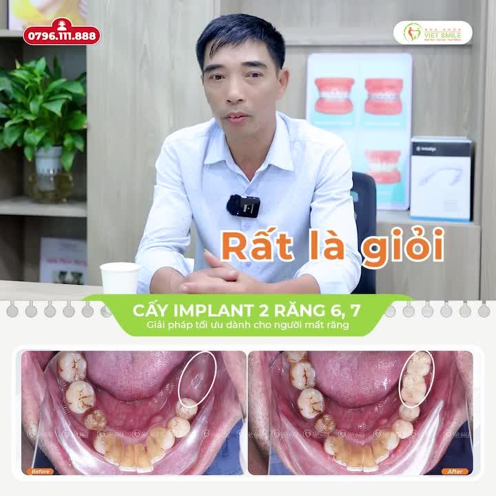 TRỒNG 2 IMPLANT, ĂN NHAI TỐT, NÂNG CAO SỨC KHOẺ -  “PHI VỤ” ĐÁNG ĐẦU TƯ NHẤT 2024