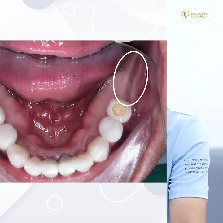 C.ẤY IMPLANT | HÀNH TRÌNH “TÌM LẠI” SỨC NHAI, NỤ CƯỜI TỰ TIN