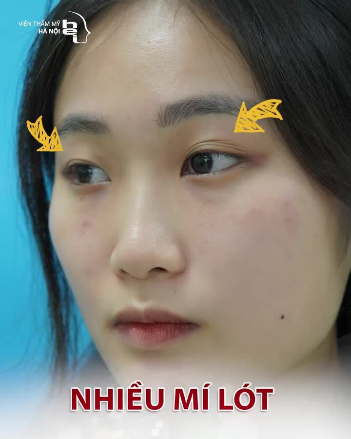 COMBO NHẤN MÍ OVAL LINE WIDE DEEP + MỞ RỘNG GÓC MẮT