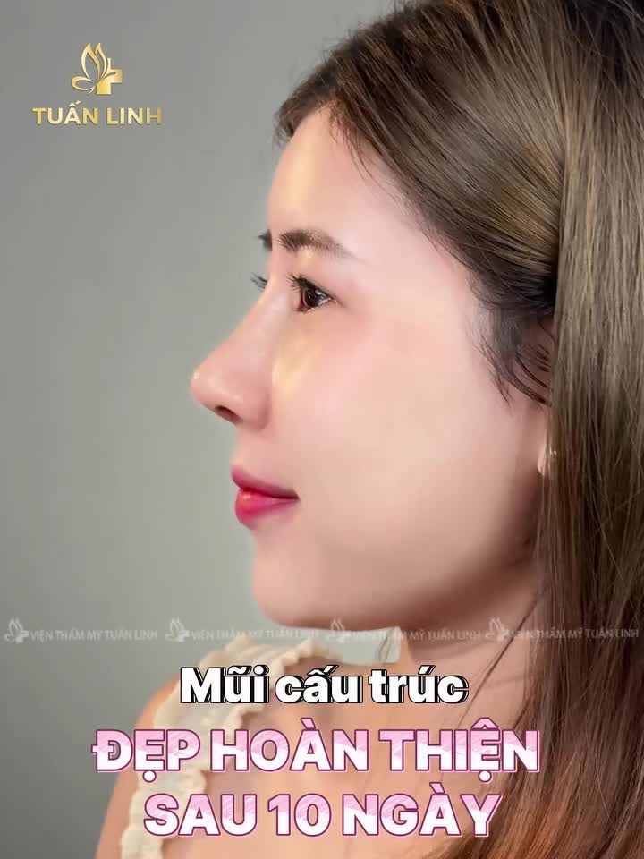NÂNG MŨI CẤU TRÚC – DÁNG MŨI HOÀN THIỆN, TỰ TIN SAU 10 NGÀY!