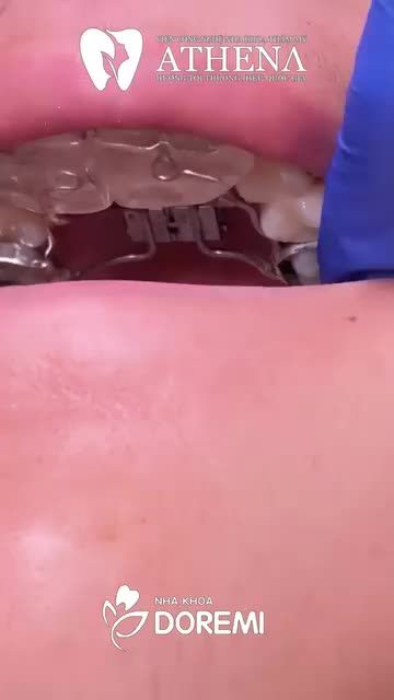 Nong hàmkhi niềng răng – Giải pháp cho hàm răng chật chội