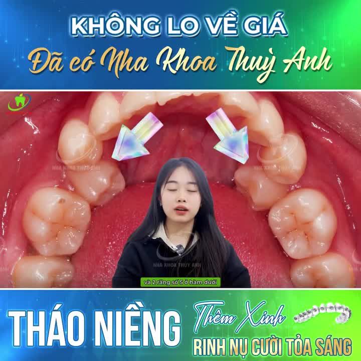 RĂNG KHẤP KHỂNH, MỌC LỆCH RA KHỎI CUNG HÀM THAY ĐỔI THẾ NÀO SAU NIỀNG RĂNG?