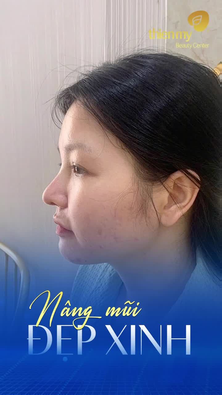 Tổng hợp những dáng mũi đẹp tại PKCK Thiện Mỹ