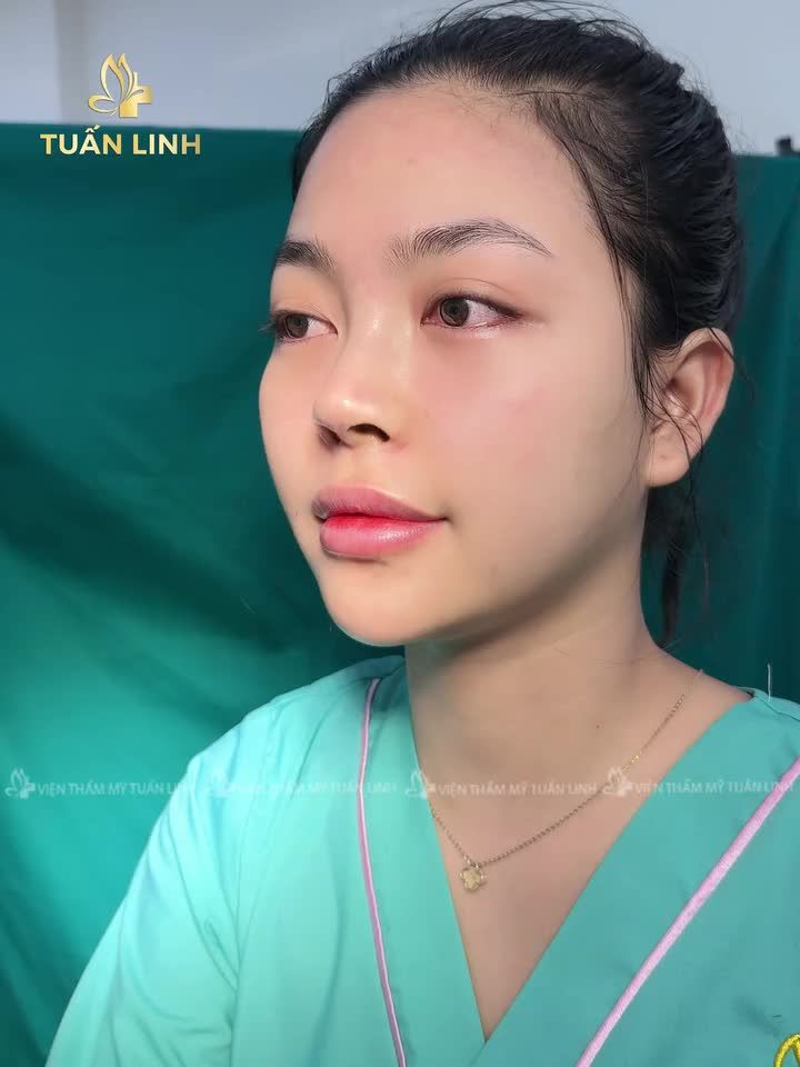 Nâng mũi bọc sụn - Ít xâm lấn - Đẹp tự nhiên - Giá siêu ưu đãi chỉ 17triệu ( trọn gói).