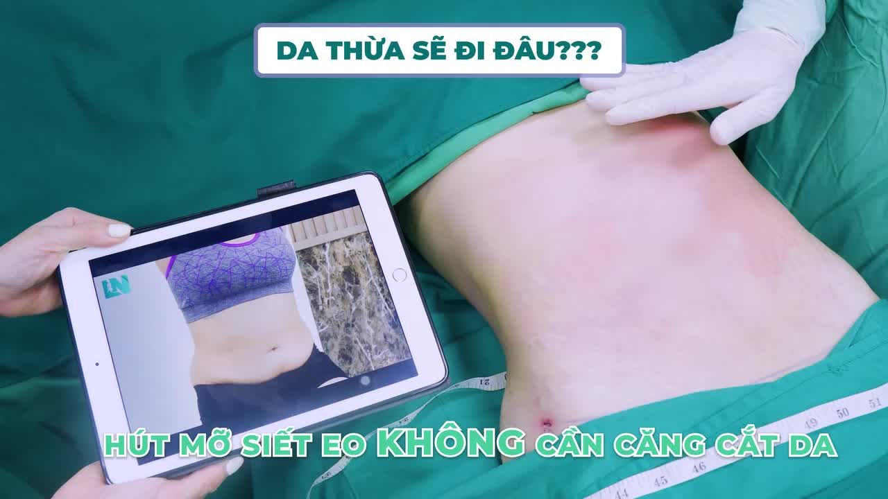HÚT MỠ SIẾT EO KHÔNG CẦN CĂNG CẮT DA THÌ DA THỪA SẼ ĐI ĐÂU