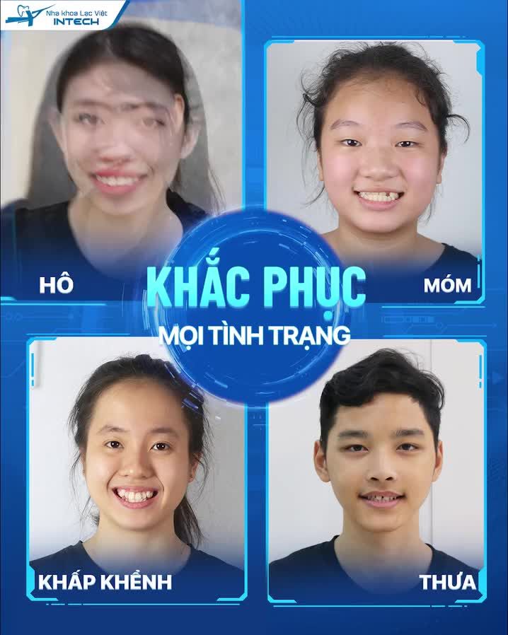 KHÔNG LO RĂNG HÔ, THƯA, MÓM, KHẤP KHỂNH VÌ ĐÃ CÓ CÔNG NGHỆ NIỀNG RĂNG X-MATRIX