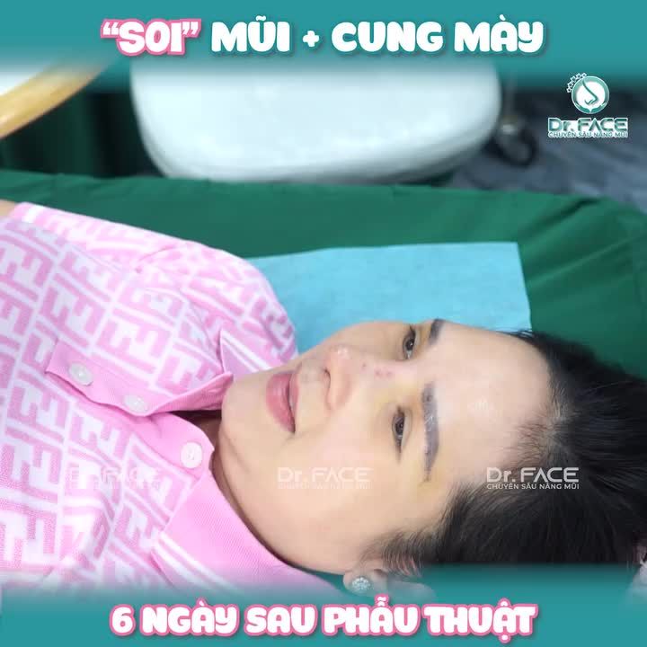 “Soi” MŨI + CUNG MÀY 6 NGÀY sau phẫu thuật