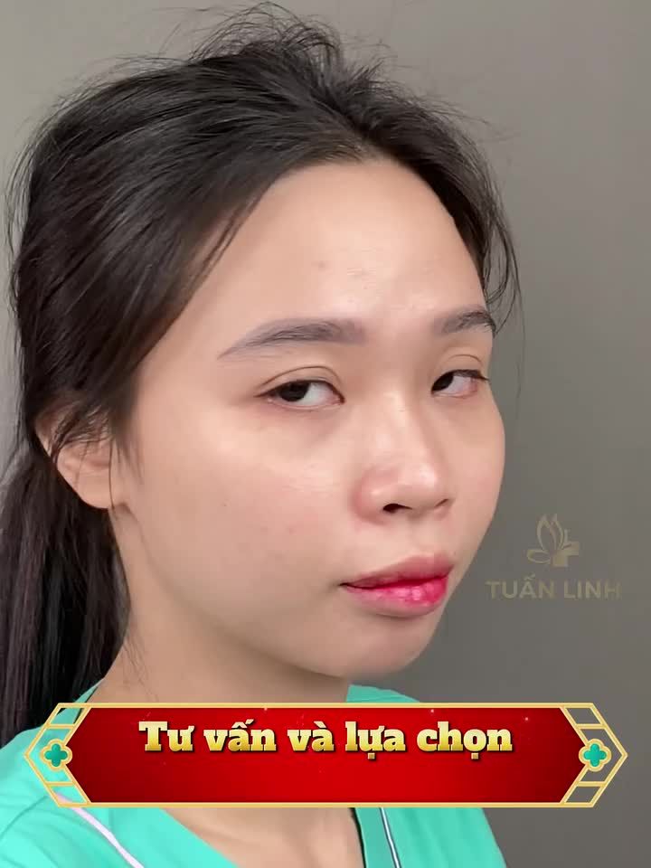 Combo Mũi + Cằm CHỈ 30tr Mũi Sline bọc sụn + độn cằm sụn Mỹ  Sở hữu ngay gương mặt thanh tú, đẹp chuẩn tỉ lệ.