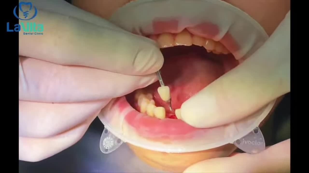 QUÁ TRÌNH LẮP RĂNG IMPLANT DIỄN RA NHƯ THẾ NÀO?