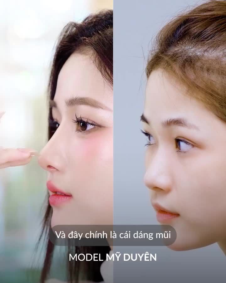 Thay đổi cả thần thái khi nâng mũi phù hợp với khuôn mặt của mình