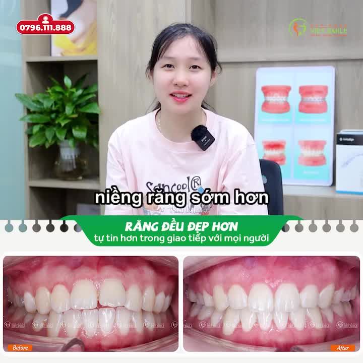 NIỀNG RĂNG THÀNH CÔNG - RẠNG RỠ NỤ CƯỜI