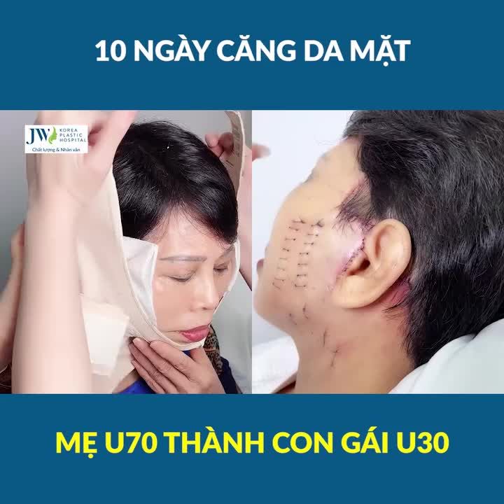 ĐỘC LẠ Bác sĩ Tú Dung CĂNG DA MẶT SMAS PRO giúp người mẹ Việt kiều U70 trẻ như con gái U30