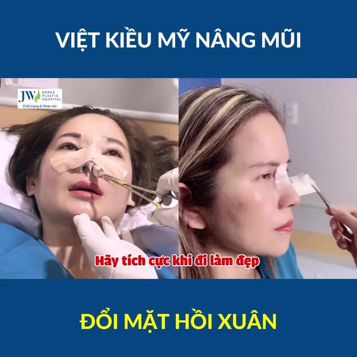 Bác sĩ Tú Dung TRÌNH LÀNG siêu phẩm Nâng mũi S Line của Chị gái Việt kiều Mỹ U50 ĐẸP XUẤT THẦN