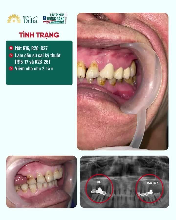 TRỒNG NHIỀU RĂNG ĐỐI VỚI KHÁCH HÀNG LỚN TUỔI LIỆU CÓ PHẢI LÀ TRỞ NGẠI?