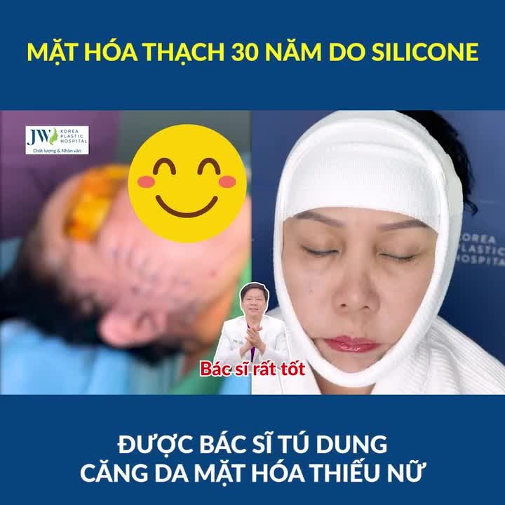 Bác sĩ Tú Dung CĂNG DA MẶT SMAS PRO cho quý bà U70 mặt hóa thạch 30 NĂM do bơm SILICONE