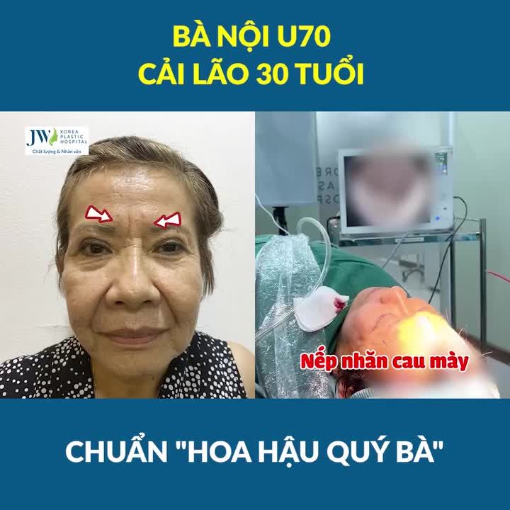 Bác sĩ Tú Dung Treo chân mày nội soi 4X, Midface 3in1 HỒI XUÂN U70 thành HOA HẬU QUÝ BÀ